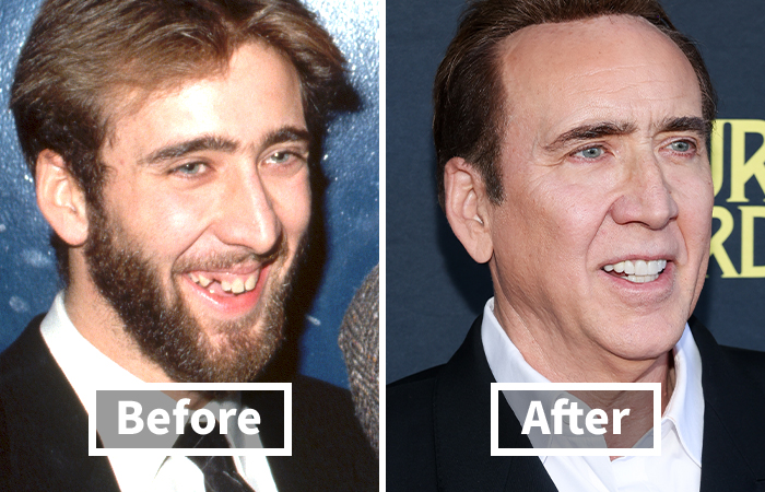 Veneers Before And After: Photos Of 15 Celebrities With The Most Dramatic Smile Makeover