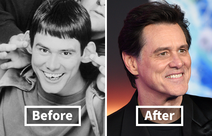 Veneers Before And After: Photos Of 15 Celebrities With The Most Dramatic Smile Makeover