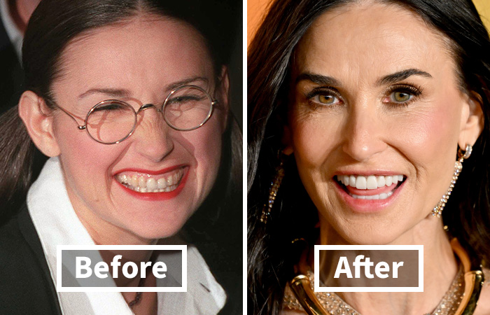 Veneers Before And After: Photos Of 15 Celebrities With The Most Dramatic Smile Makeover