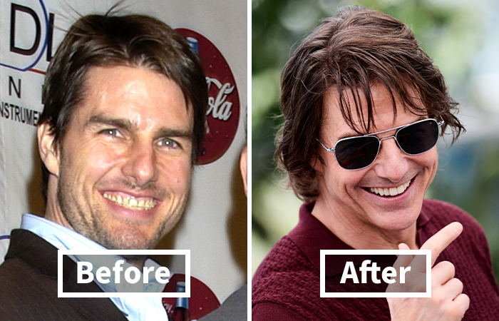 Veneers Before And After: Photos Of 15 Celebrities With The Most Dramatic Smile Makeover