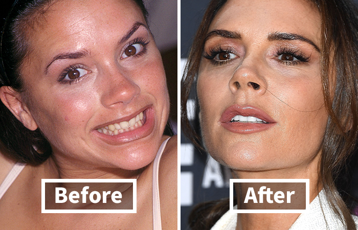 Veneers Before And After: Photos Of 15 Celebrities With The Most Dramatic Smile Makeover