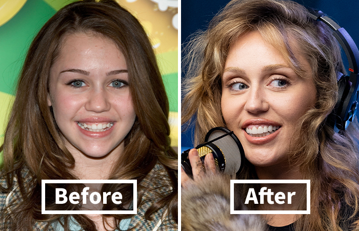 Veneers Before And After: Photos Of 15 Celebrities With The Most Dramatic Smile Makeover