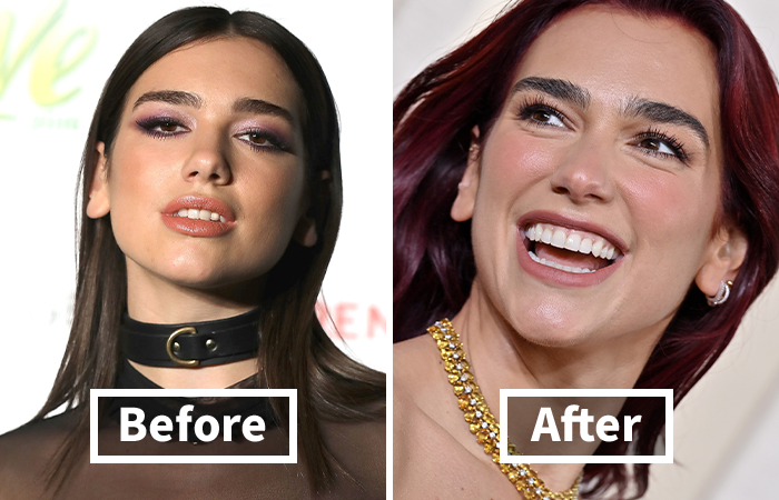 Veneers Before And After: Photos Of 15 Celebrities With The Most Dramatic Smile Makeover