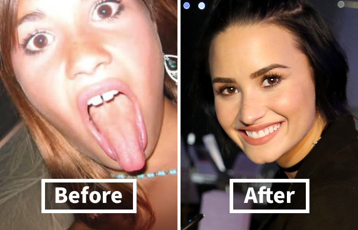 Veneers Before And After: Photos Of 15 Celebrities With The Most Dramatic Smile Makeover