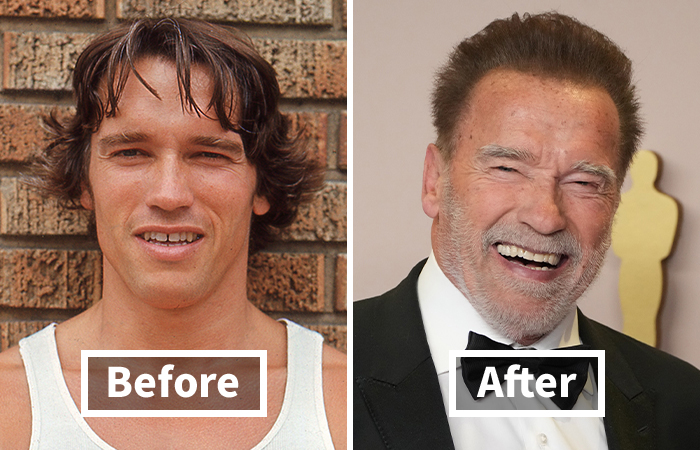 Veneers Before And After: Photos Of 15 Celebrities With The Most Dramatic Smile Makeover