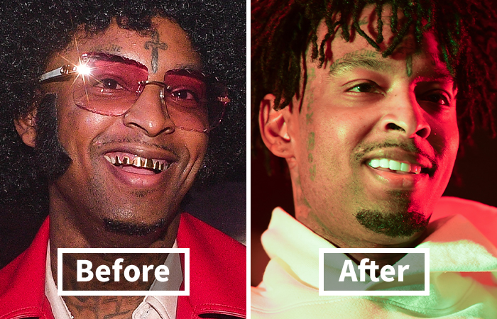 Veneers Before And After: Photos Of 15 Celebrities With The Most Dramatic Smile Makeover