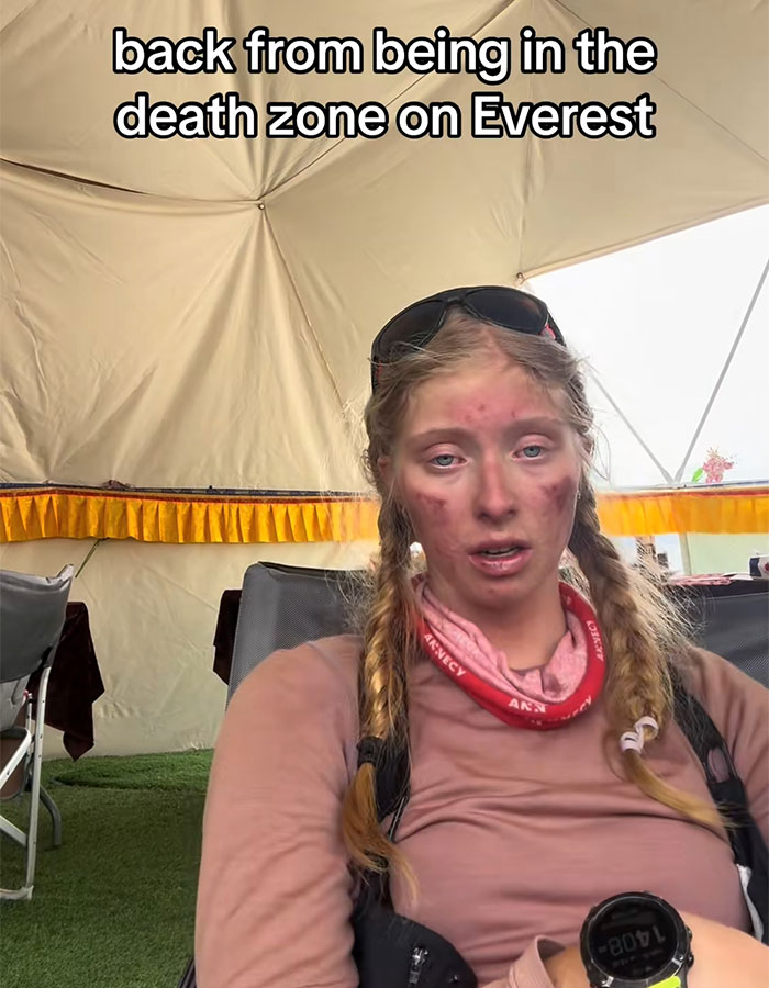 Severely Injured After Everest Climb, 17YO Teen Sparks Online Debate: “Why Take The Risk?”