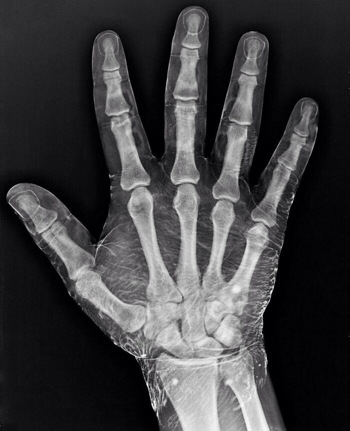 74 People Share Rare And Surprising Things About Their Bodies (New Pics)