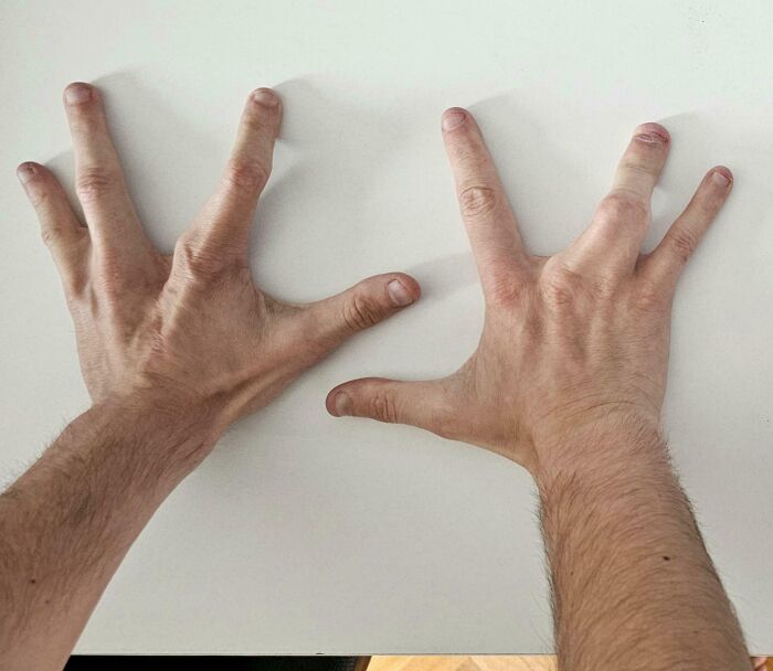 74 People Share Rare And Surprising Things About Their Bodies (New Pics)