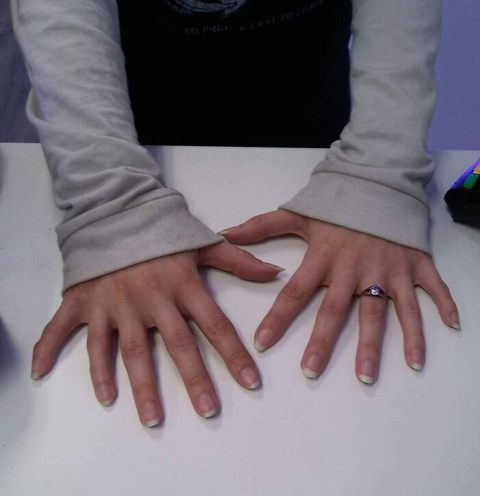 74 People Share Rare And Surprising Things About Their Bodies (New Pics)