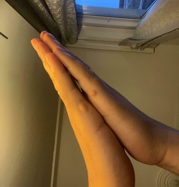 74 People Share Rare And Surprising Things About Their Bodies (New Pics)