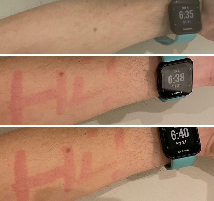 74 People Share Rare And Surprising Things About Their Bodies (New Pics)