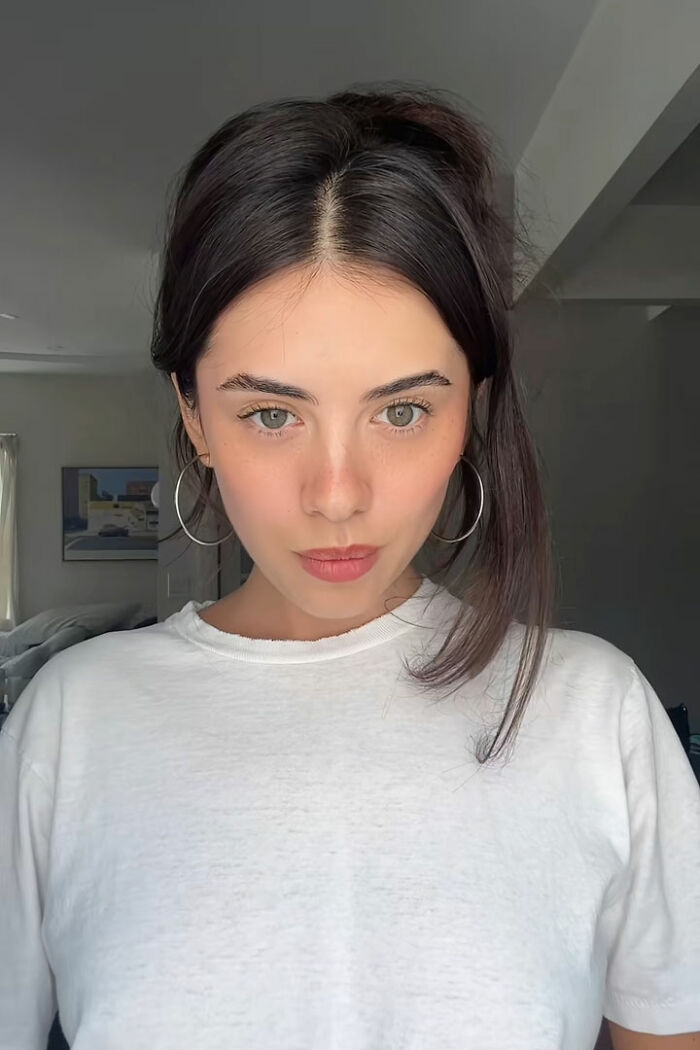 Woman&#8217;s &#8216;Kybella&#8217; Face Transformation Stuns People After Her Extreme Recovery Phase Goes Viral