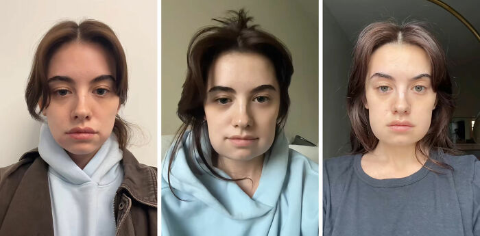 Woman&#8217;s &#8216;Kybella&#8217; Face Transformation Stuns People After Her Extreme Recovery Phase Goes Viral