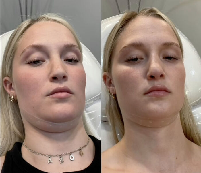 Woman&#8217;s &#8216;Kybella&#8217; Face Transformation Stuns People After Her Extreme Recovery Phase Goes Viral