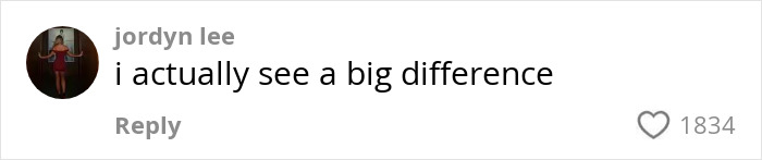 Woman&#8217;s &#8216;Kybella&#8217; Face Transformation Stuns People After Her Extreme Recovery Phase Goes Viral