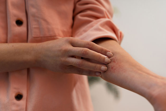 “The Room Exploded”: Teen Tries To Hide Allergic Reaction And It Doesn’t End Well