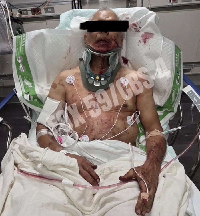 After Elderly Man Was Brutally Beaten By Mark Sanchez, Family Gives Heartbreaking Update