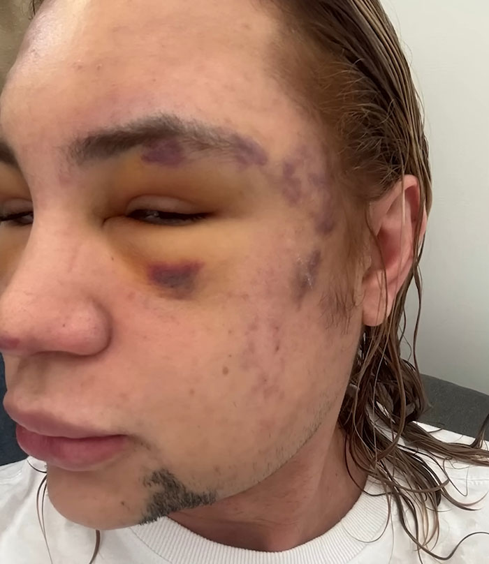 Influencer Passes Away After Exposing Complications From Popular &#8216;Fox Eyes’ Surgery