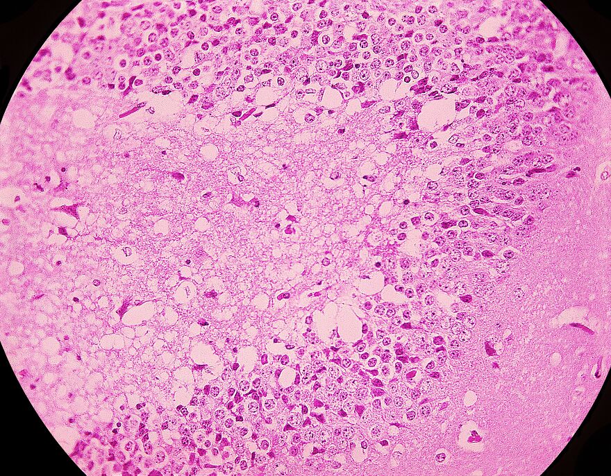 Trypophobia Explained: Why Your Brain Reacts To Tiny Holes Trypophobia Explained: Why Your Brain Reacts To Tiny Holes