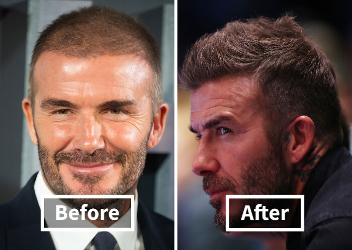 19 Celebrities Who Look Noticeably Better After Hair Transplants