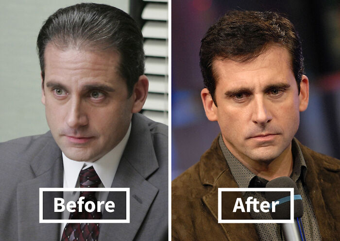19 Celebrities Who Look Noticeably Better After Hair Transplants