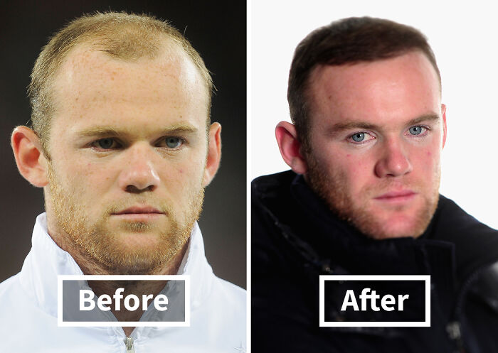 19 Celebrities Who Look Noticeably Better After Hair Transplants
