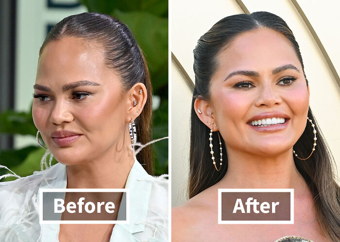 19 Celebrities Who Look Noticeably Better After Hair Transplants