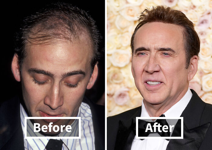 19 Celebrities Who Look Noticeably Better After Hair Transplants