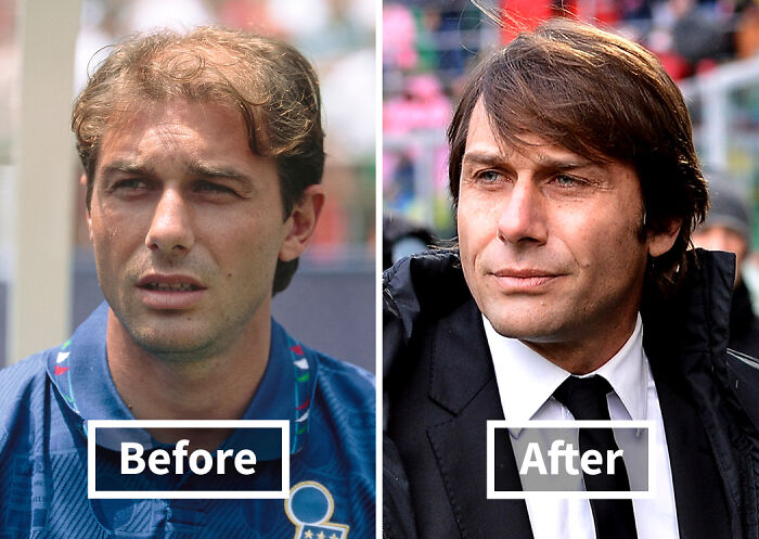 19 Celebrities Who Look Noticeably Better After Hair Transplants