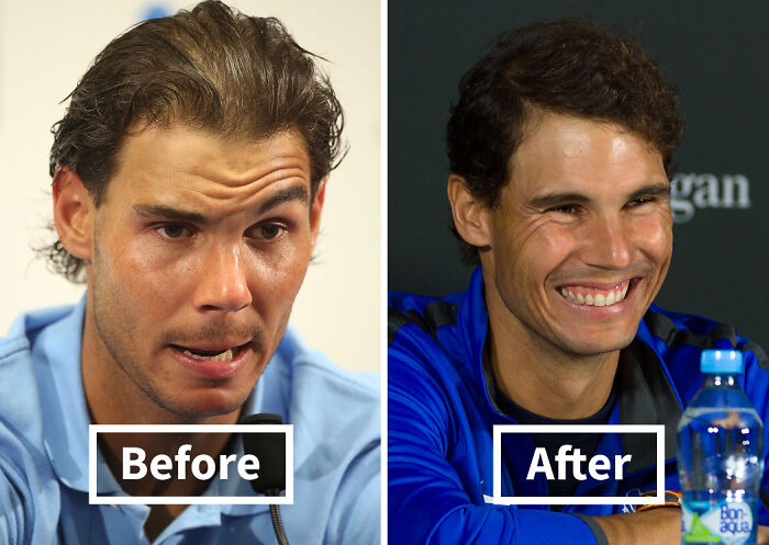 19 Celebrities Who Look Noticeably Better After Hair Transplants