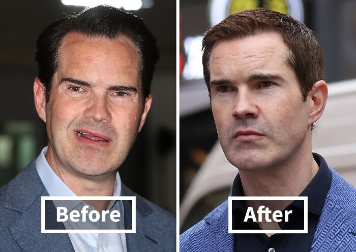 19 Celebrities Who Look Noticeably Better After Hair Transplants