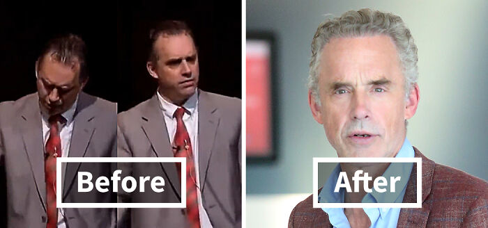19 Celebrities Who Look Noticeably Better After Hair Transplants