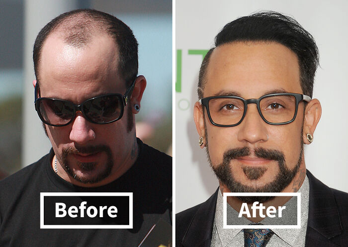 19 Celebrities Who Look Noticeably Better After Hair Transplants