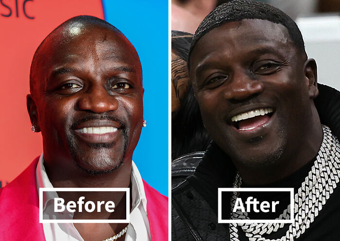 19 Celebrities Who Look Noticeably Better After Hair Transplants