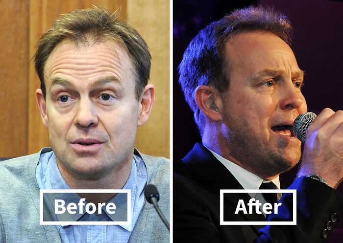 19 Celebrities Who Look Noticeably Better After Hair Transplants