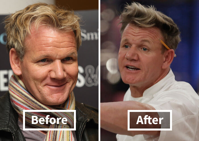 19 Celebrities Who Look Noticeably Better After Hair Transplants