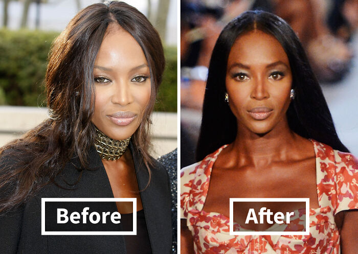 19 Celebrities Who Look Noticeably Better After Hair Transplants