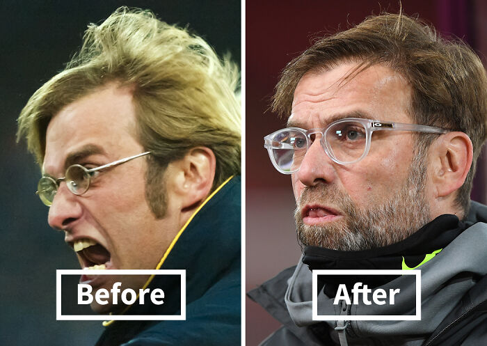 19 Celebrities Who Look Noticeably Better After Hair Transplants