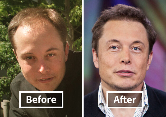 19 Celebrities Who Look Noticeably Better After Hair Transplants
