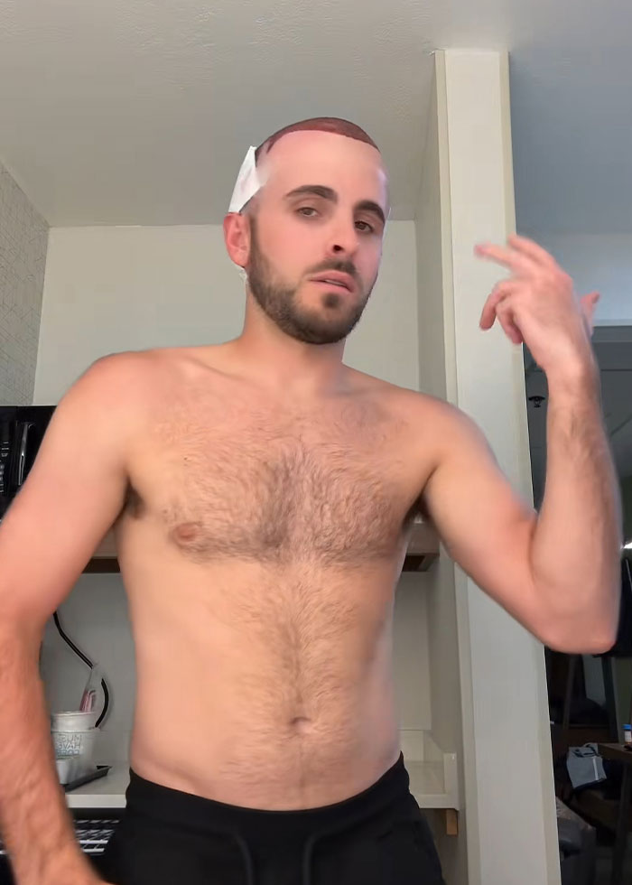 “I Literally Look Like An Egg”: TikToker’s Hair Transplant Recovery Has Everyone Cracking Up