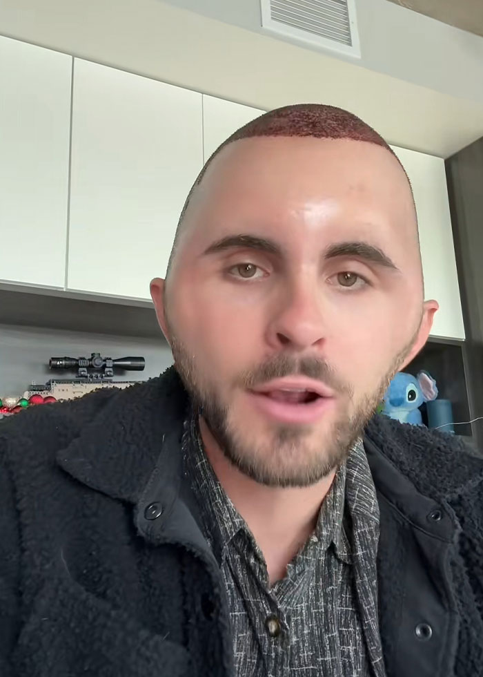 “I Literally Look Like An Egg”: TikToker’s Hair Transplant Recovery Has Everyone Cracking Up