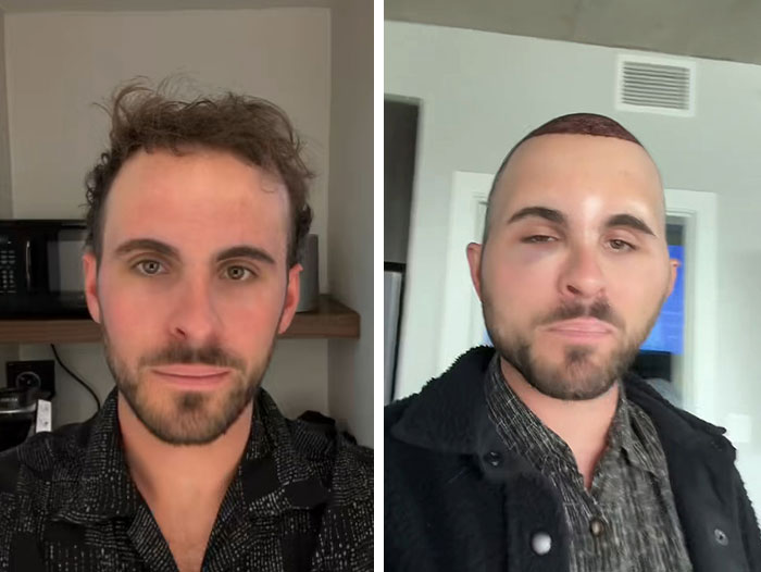 “I Literally Look Like An Egg”: TikToker’s Hair Transplant Recovery Has Everyone Cracking Up