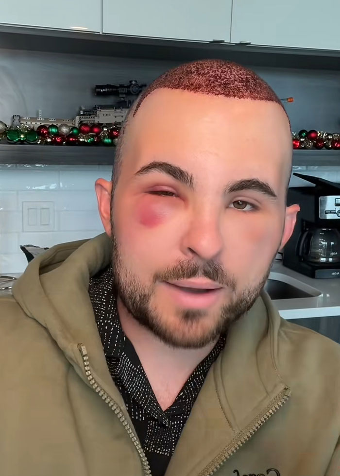 “I Literally Look Like An Egg”: TikToker’s Hair Transplant Recovery Has Everyone Cracking Up