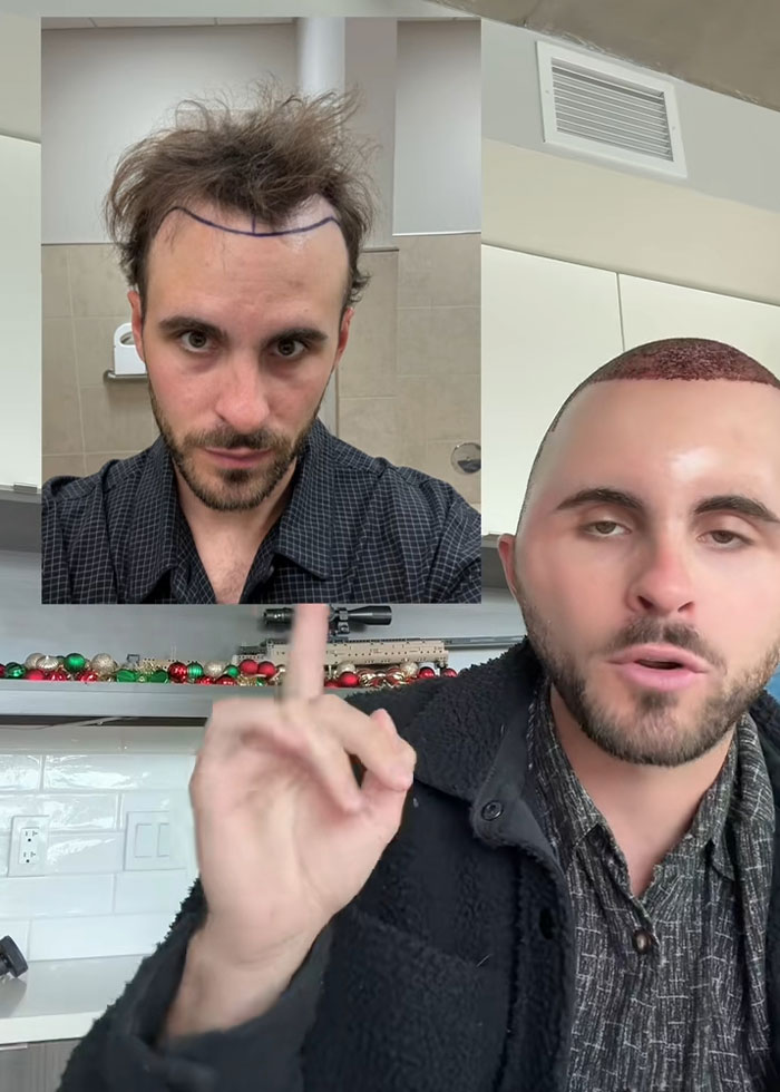 “I Literally Look Like An Egg”: TikToker’s Hair Transplant Recovery Has Everyone Cracking Up
