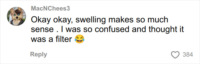 “I Literally Look Like An Egg”: TikToker’s Hair Transplant Recovery Has Everyone Cracking Up