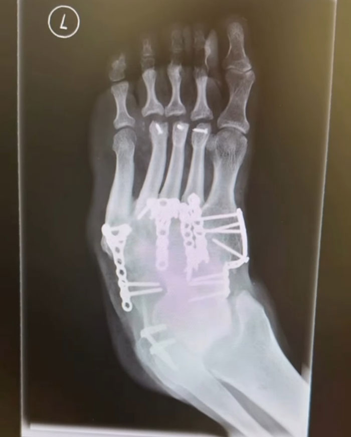 20-Year-Old Decided To Amputate His Leg After Going To A Rock Concert, Breaks His Silence On Why