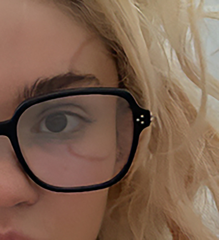 “Ringworm”: Elon Musk’s Ex Grimes Stuns Fans With “Insane” Face Tattoo “Ringworm”: Elon Musk’s Ex Grimes Stuns Fans With “Insane” Face Tattoo