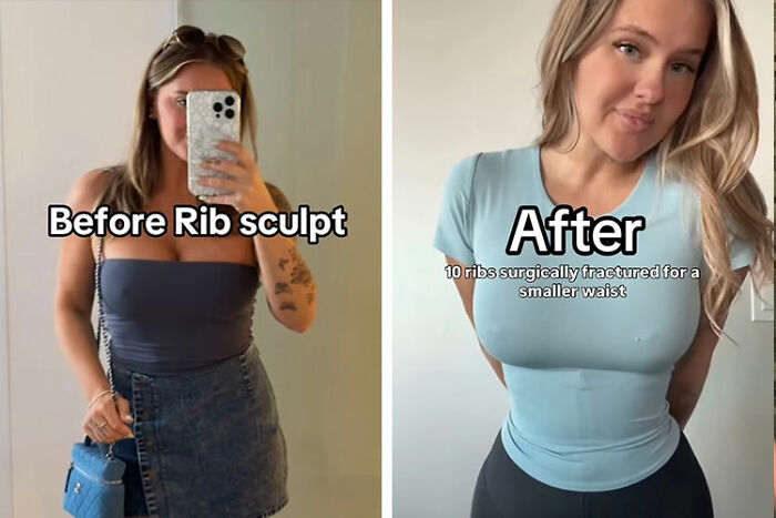 Mom Who Got Her Ribs Broken To Make Waist &#8216;Smaller&#8217; Reveals Transformation In Before-And-After Clips