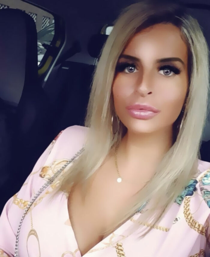 Woman Who Cut Her Nose Off Shares Shocking Before-And-After Pics Woman Who Cut Her Nose Off Shares Shocking Before-And-After Pics